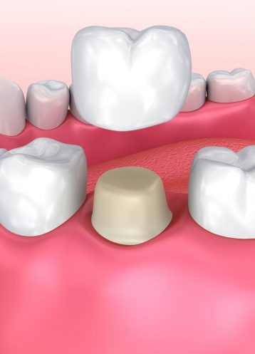 Crowns - Treatment