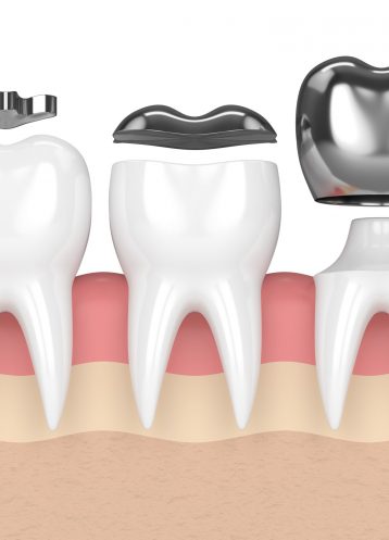 Inlays and Onlays - Treatment