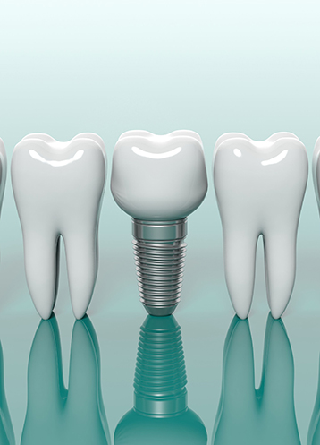 Dental Implants - Treatment